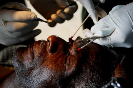 US Navy 080813-N-7544A-124 Cmdr. Brian A. Alexander and Hospital Corpsman 3rd Class Richard J. Utley perform eye surgery on Nicaraguan citizen Edwin Moore during a Continuing Promise 2008 humanitarian assistance project photo