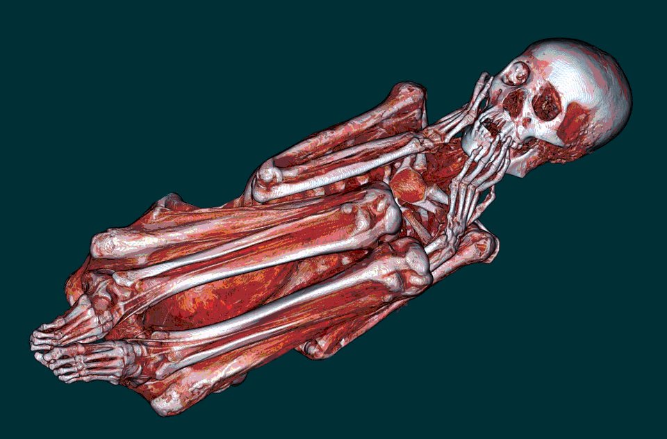 US Navy 110427-N-YY999-001 A CT scan of a Peruvian mummy taken at Naval Medical Center San Diego provides details of the muscular and skeletal stru