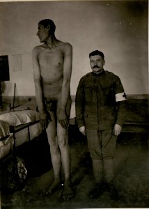 Villach, Salubr.Kommission.10. Acromegalie bei einem montenegrinischen Kriegsgefangenen, (BildID 15801010)