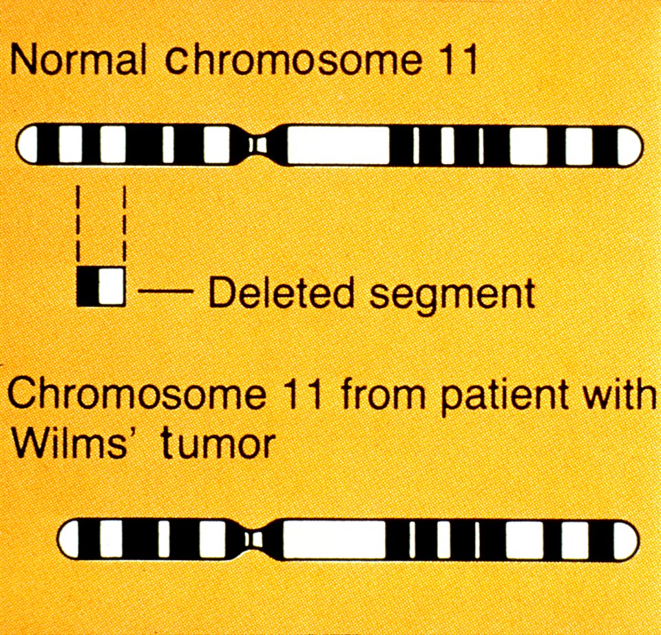 Wilms' tumor illustration