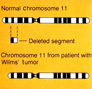 Wilms' tumor illustration