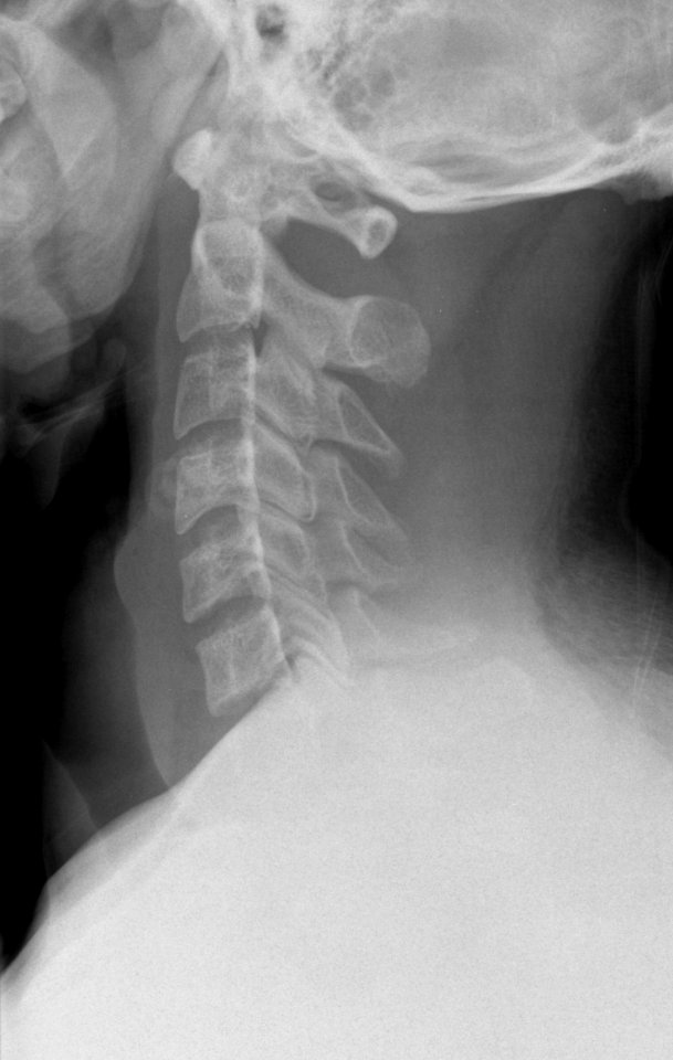 X-ray of the cervical spine of a 20 year old male - lateral