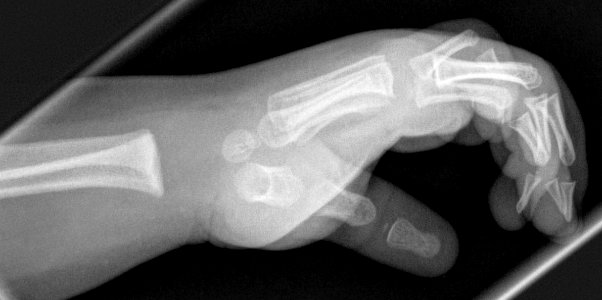 X-ray of the hand of a 2 year old male - lateral