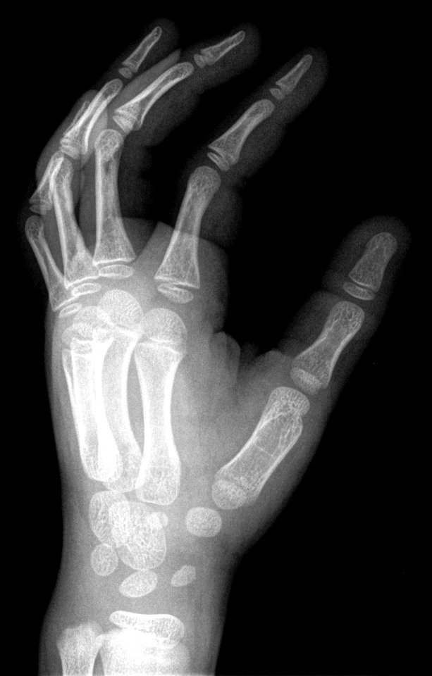 X-ray of the hand of a 5 year old male - case 2 - lateral