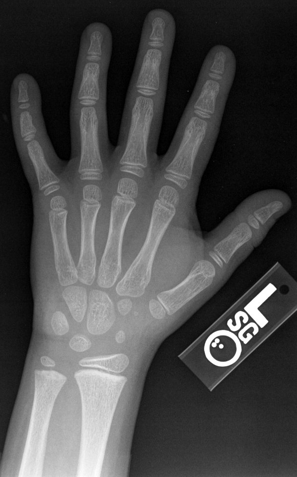 X-ray of the hand of a 9 year old male - case 2 - dorsoplantar