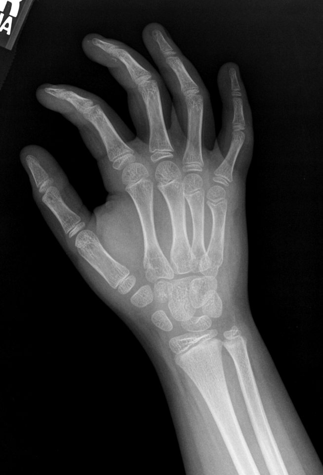 X-ray of the hand of an 8 year old male - oblique