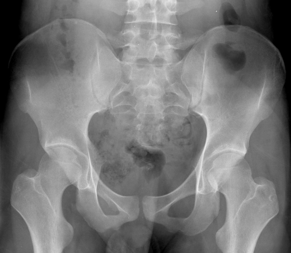 X-ray of the pelvis of an 18 year old male - case 2 - anteroposterior