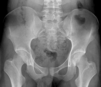 X-ray of the pelvis of an 18 year old male - case 2 - anteroposterior