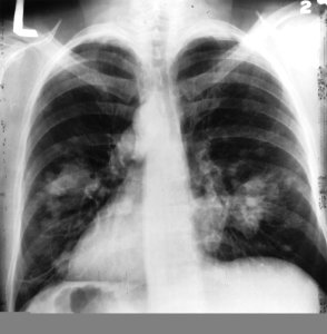 X-ray(Chest)Cancer photo