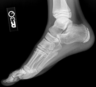 X-ray of a normal foot of a 12 year old male - lateral photo
