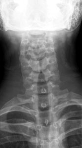 X-ray of the cervical spine of an 20 year old male - anteroposterior, case 2
