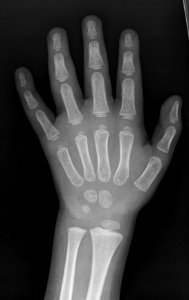 X-ray of the hand of a 3 year old male - dorsoplantar photo
