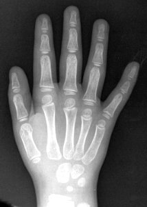 X-ray of the hand of a 5 year old male - dorsoplantar
