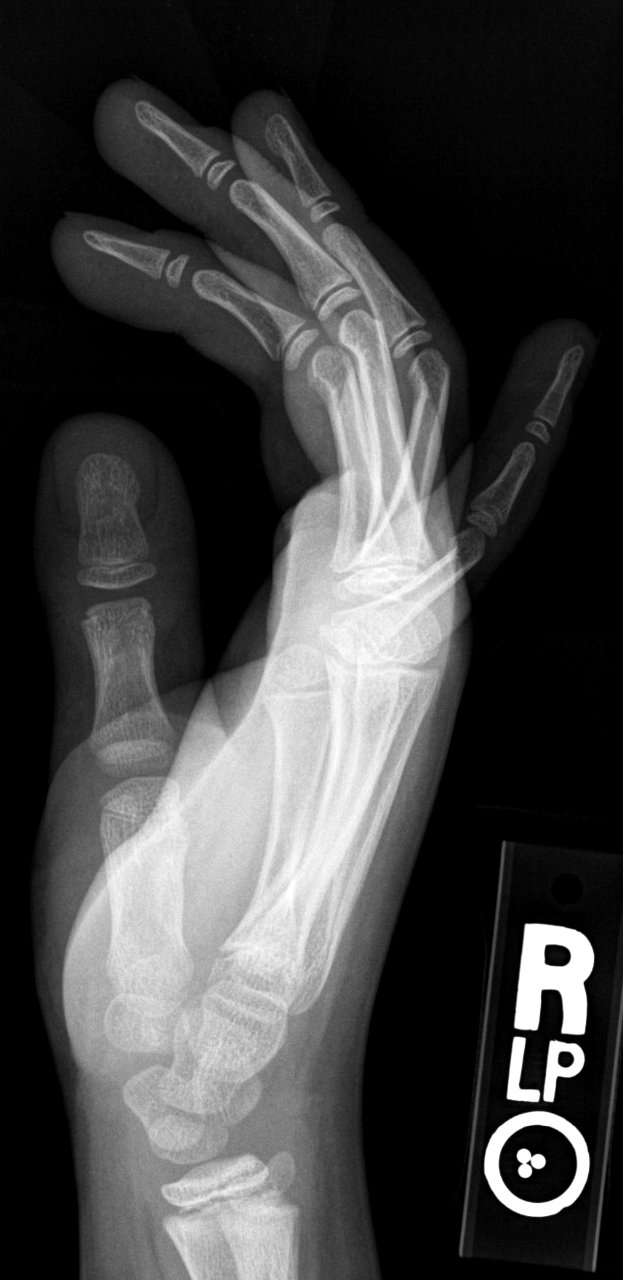 X-ray of the hand of a 9 year old male - lateral