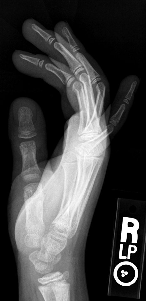 X-ray of the hand of a 9 year old male - lateral