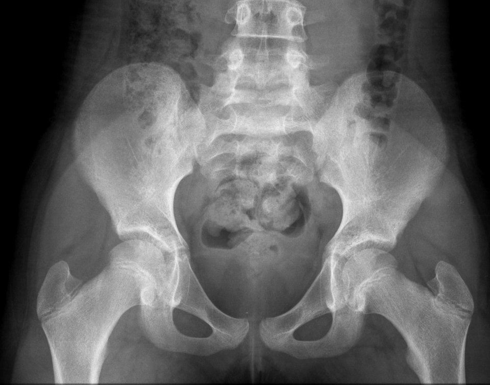 X-ray of the pelvis of a 10 year old female - case 1 - anteroposterior