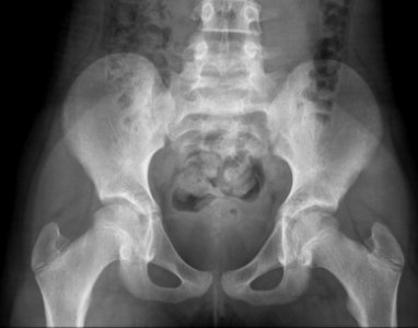 X-ray of the pelvis of a 10 year old female - case 1 - anteroposterior