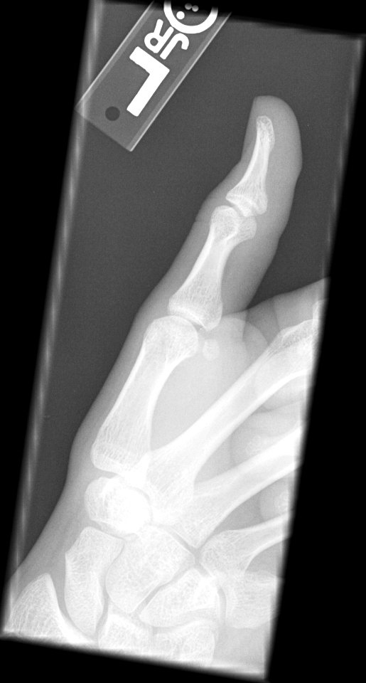 X-ray of the thumb of an 18 year old male - lateral