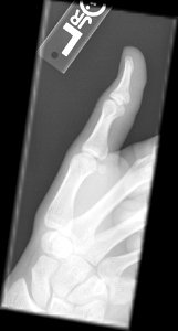 X-ray of the thumb of an 18 year old male - lateral