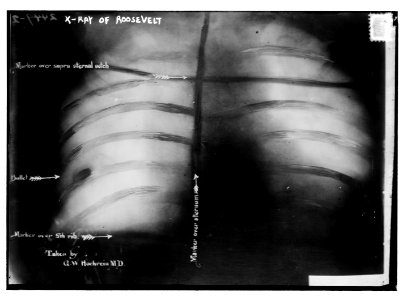 X-Ray of Roosevelt (shows bullet) LCCN2014690853 photo