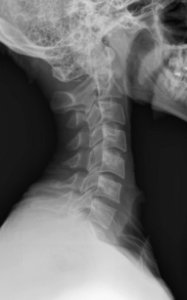 X-ray of the cervical spine of an 20 year old male - lateral, case 2