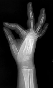 X-ray of the hand of a 4 year old male - lateral