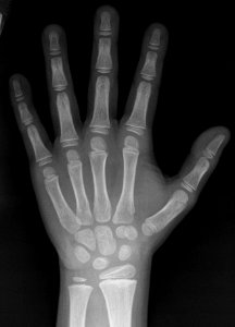 X-ray of the hand of a 7 year old male - case 2 - dorsoplantar