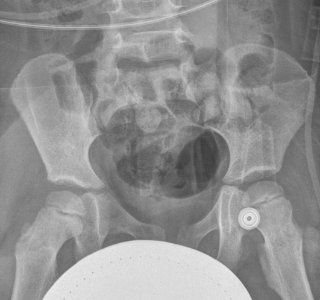 X-ray of the pelvis of a 3 year old male - case 3 - anteroposterior