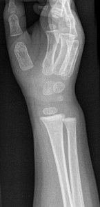 X-ray of the wrist of a 2 year old male - oblique
