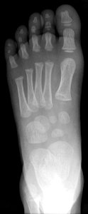 X-ray of a normal foot of a 3 year old male - dorsoplantar photo