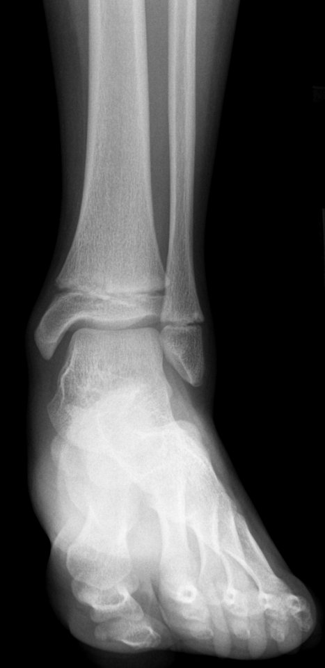 X-ray of the ankle of a 9 year old female - case 1 - anteroposterior