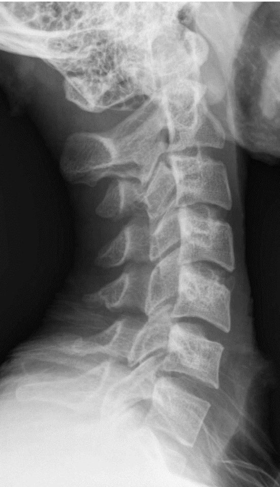 X-ray of the cervical spine of an 20 year old male - lateral, case 2, crop