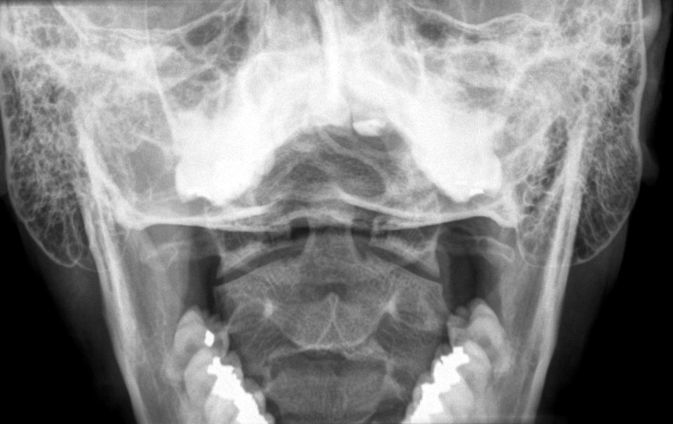 X-ray of the cervical spine of an 20 year old male - odontoid, case 2
