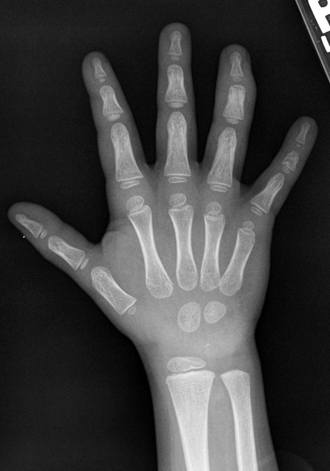 X-ray of the hand of a 4 year old male - dorsoplantar