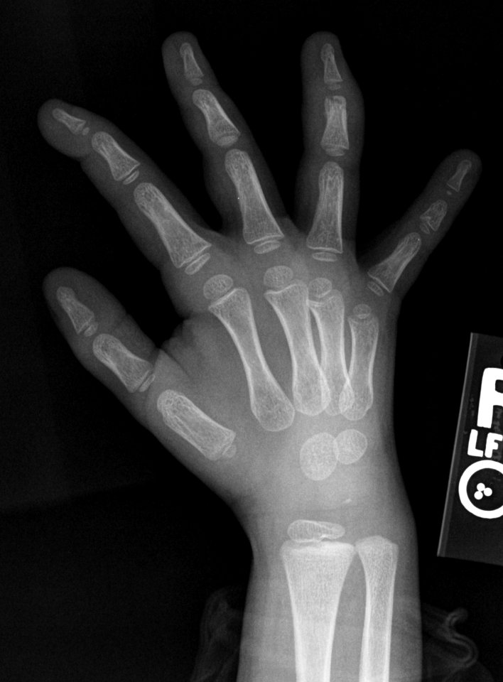X-ray of the hand of a 4 year old male - oblique