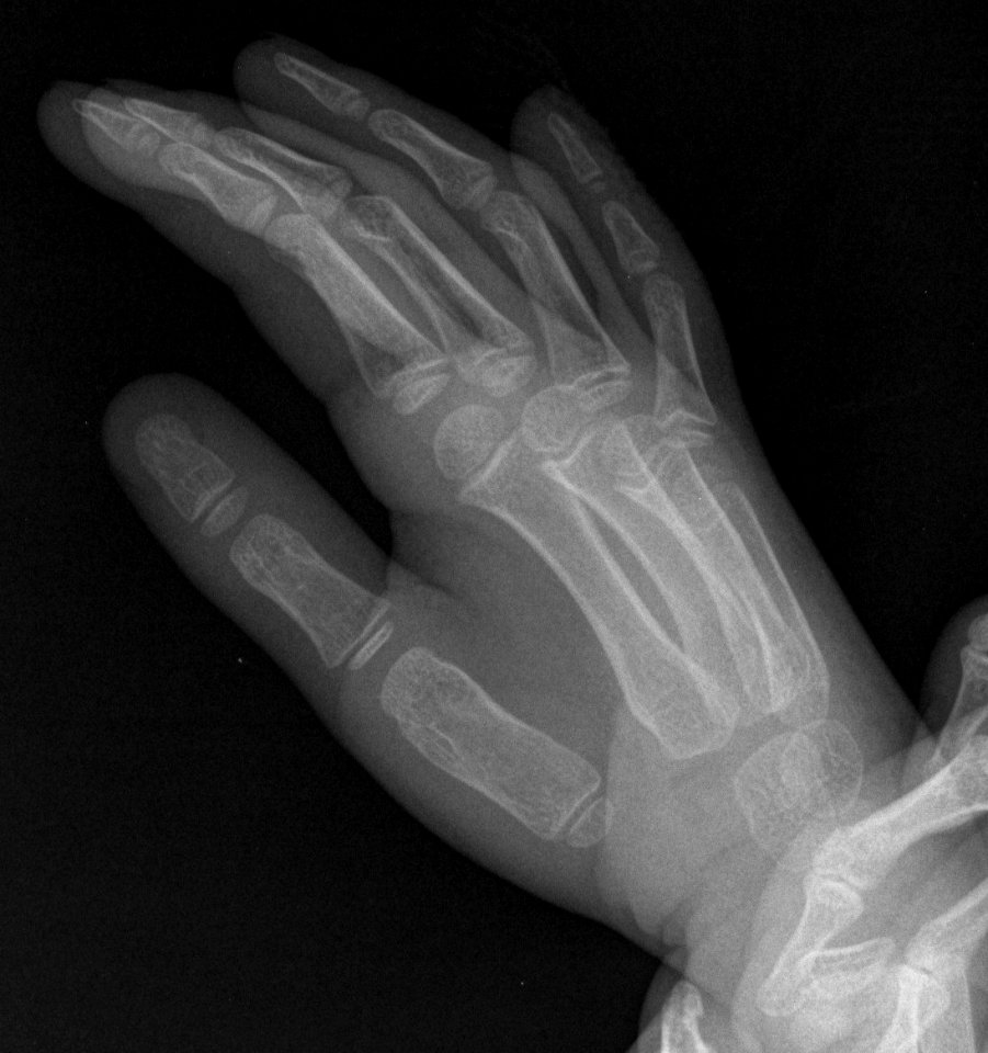 X-ray of the hand of a 5 year old male - oblique