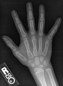 X-ray of the hand of a 7 year old male - dorsoplantar