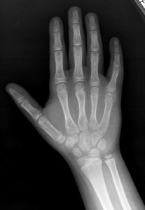 X-ray of the hand of an 8 year old male - case 1 - dorsoplantar