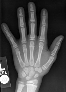 X-ray of the hand of an 8 year old male - case 3 - dorsoplantar