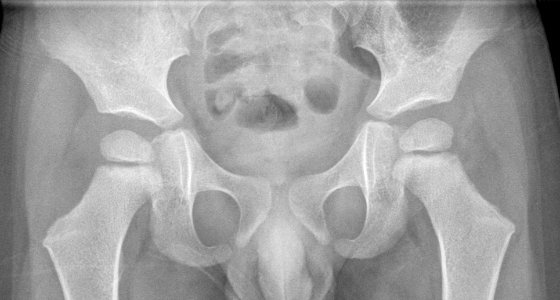X-ray of the pelvis of a 3 year old male - case 2 - anteroposterior