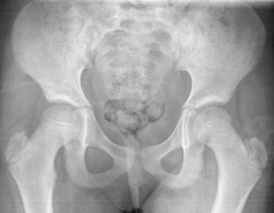 X-ray of the pelvis of a 9 year old female - case 1 - anteroposterior