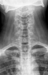 X-ray of the cervical spine of a 20 year old male - anteroposterior