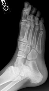 X-ray of a normal foot of a 12 year old male - oblique