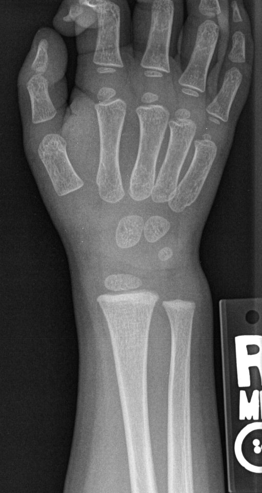 X-ray of the wrist of a 2 year old male - posteroanterior 2