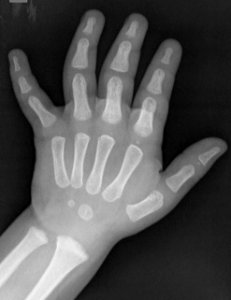X-ray of the hand of a 2 year old male - dorsoplantar