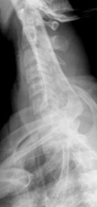X-ray of the cervical spine of an 20 year old male - cervicothoracic, case 1