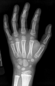 X-ray of the hand of a 5 year old male - case 2 - dorsoplantar