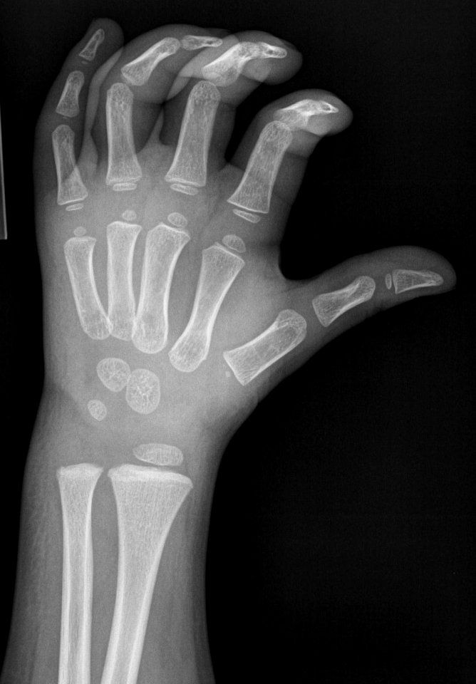 X-ray of the hand of a 3 year old male - oblique