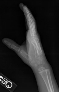 X-ray of the hand of a 7 year old male - lateral