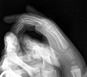 X-ray of the hand of a 5 year old male - lateral photo